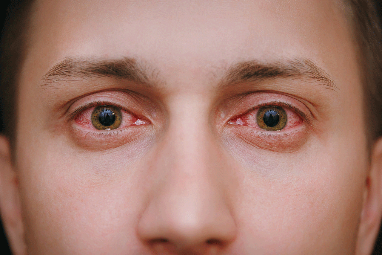 Why Does Weed Make Eyes Red? | Clearbrook Centers